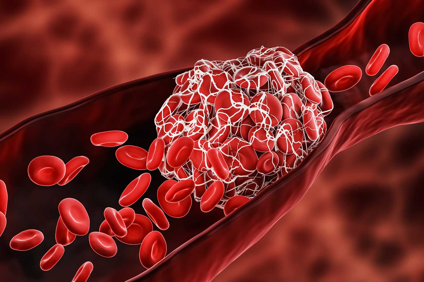 FREE BLOOD CLOTS WITH EVERY COVID JAB - DR VERNON COLEMAN - Fringe News